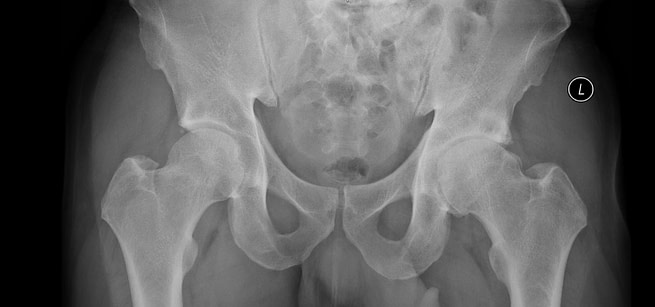 Osteoarthritis-Hip X-Ray.jpeg