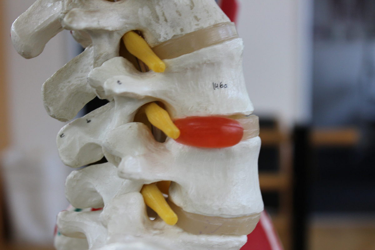 Sciatica, prolapsed disc and slipped disc treatment through Applied Pilates at The Sogunro Practice, London Colney, St Albans — rehabilitation-informed approach to nerve pain and disc-related back pain.