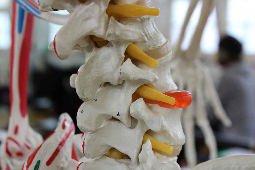 Lumbar spine model with one intervertebral disc highlighted to show a disc bulge
