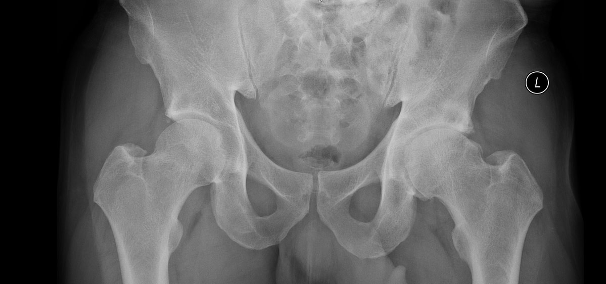 Hip osteoarthritis X-ray showing degenerative joint changes — The Sogunro Practice, London Colney, St Albans. Applied Pilates and Osteolates Therapy for safe, joint-friendly exercise with osteoarthritis.